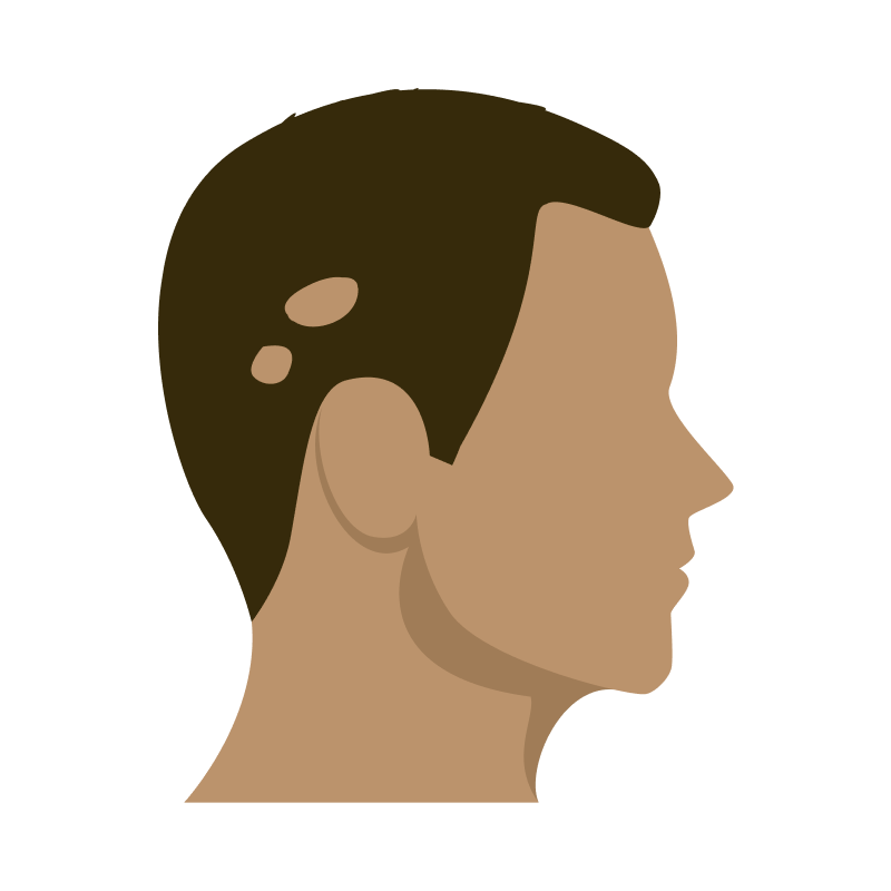 Bald patches