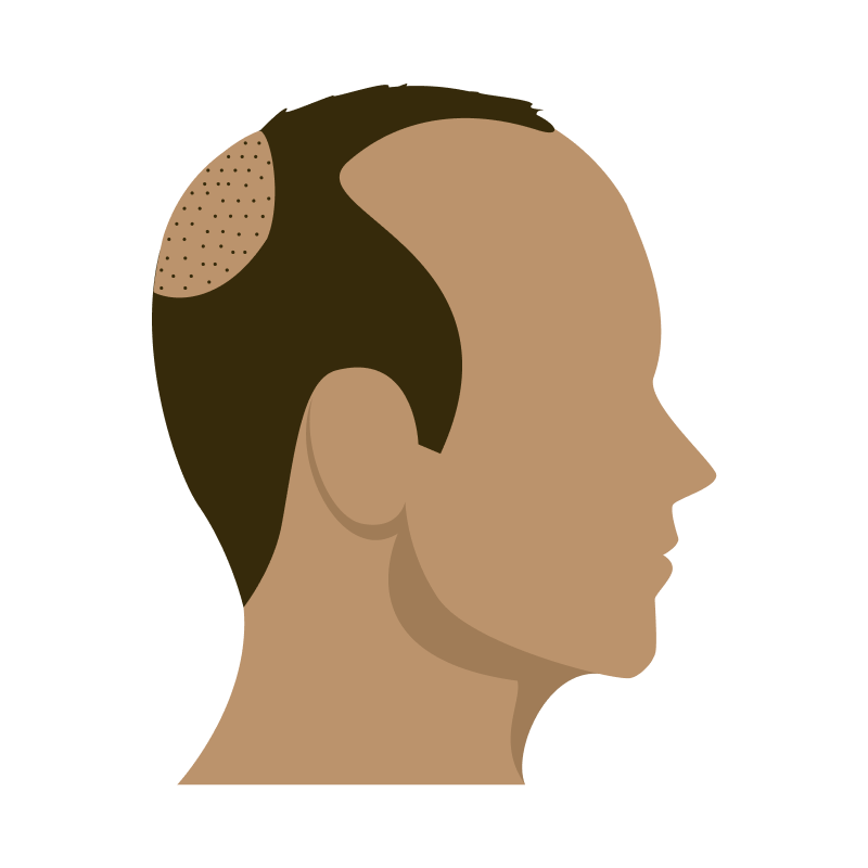 Thinning top