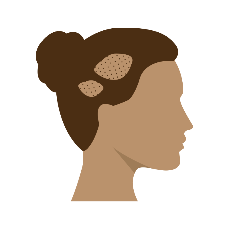 Bald patches